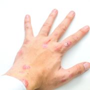 Lesson 5: Hand Injuries and First Aid